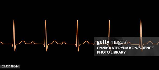 First Ecg Line Ecg Displaying First Degree Av Block Illustration High-Res Vector ...