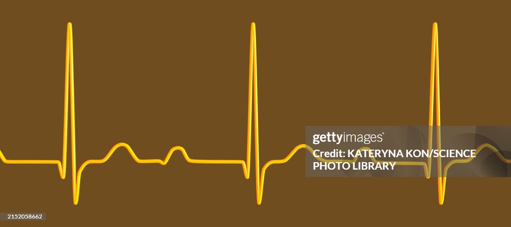 First Ecg Line Ecg Displaying First Degree Av Block Illustration High-Res Vector ...