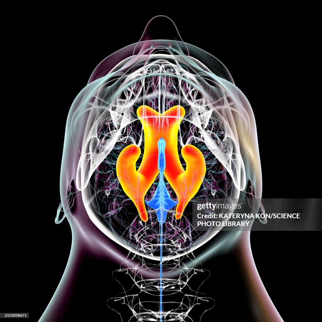 Oxbrain Enlarged Lateral Ventricles Of The Brain Illustration High-Res Vector ...