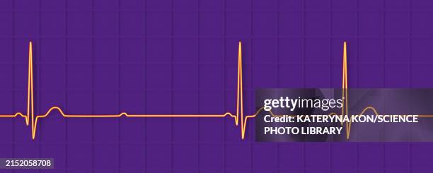 ecg with second degree mobitz 2 av block, illustration - av stock illustrations