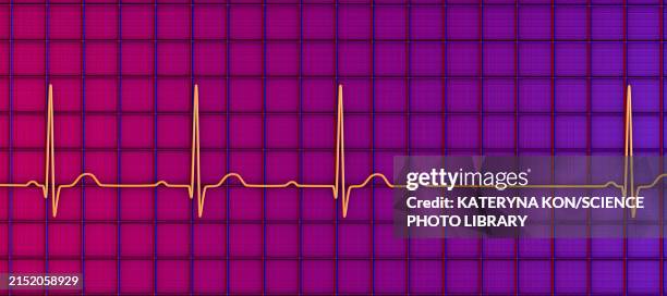 ecg with second degree av block, illustration - av stock illustrations