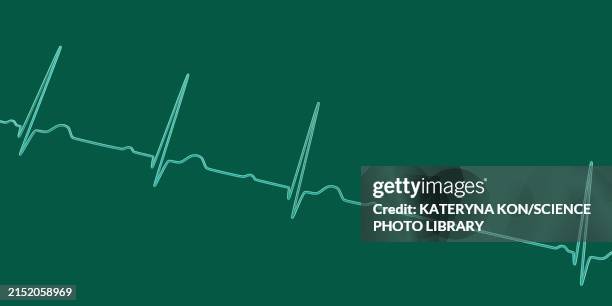 ecg with second degree av block, illustration - av stock illustrations