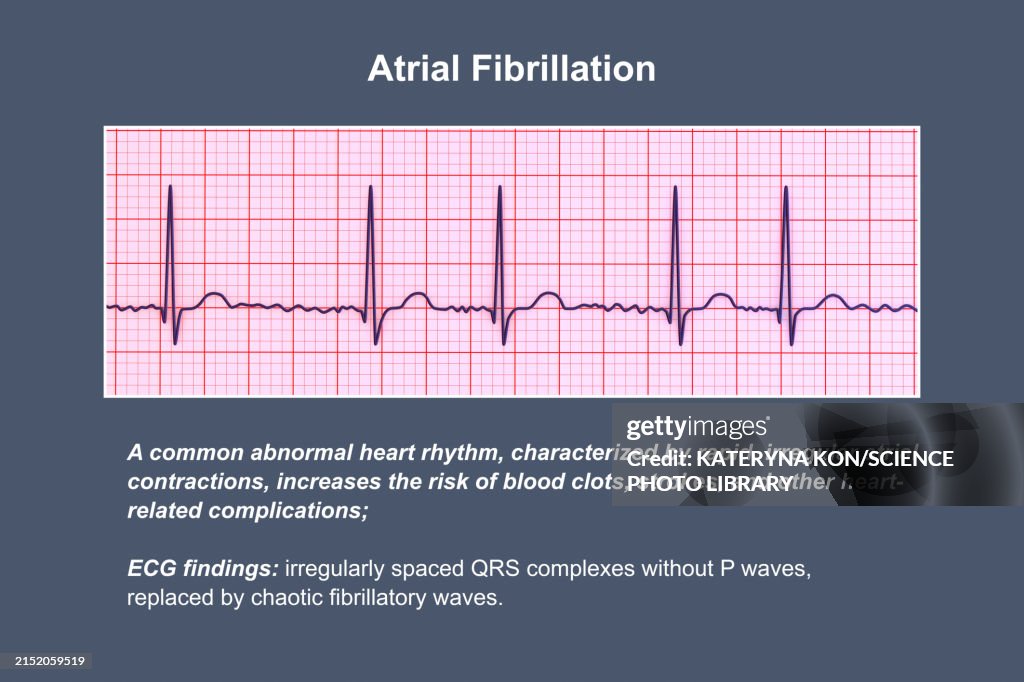 ECG in atrial fibrillation, illustration