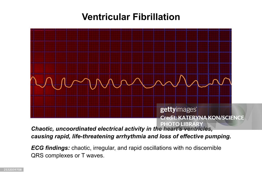 Vi Fib Ecg In Ventricular Fibrillation Illustration High-Res Vector Graphic ...