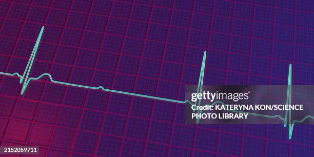 ecg with second degree mobitz 2 av block, illustration - av stock illustrations