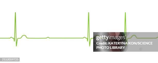ecg with second degree mobitz 2 av block, illustration - av stock illustrations
