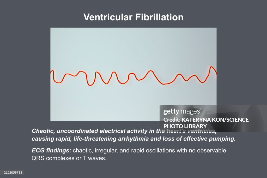 Vf Wave Ecg In Ventricular Fibrillation Illustration High-Res Vector Graphic ...