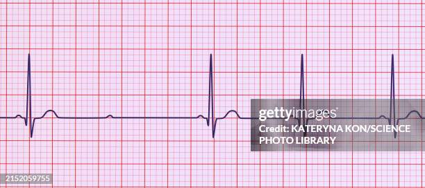ecg with second degree mobitz 2 av block, illustration - av stock illustrations