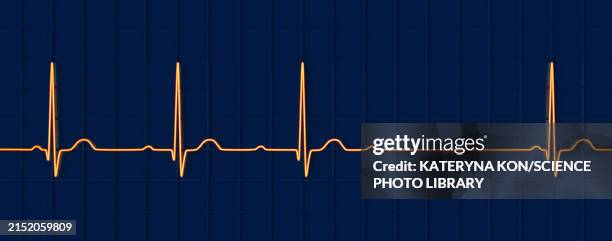 ecg with second degree av block, illustration - av stock illustrations