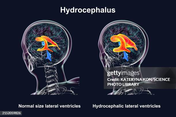 enlarged and normal lateral ventricles, illustration - distorted body stock illustrations