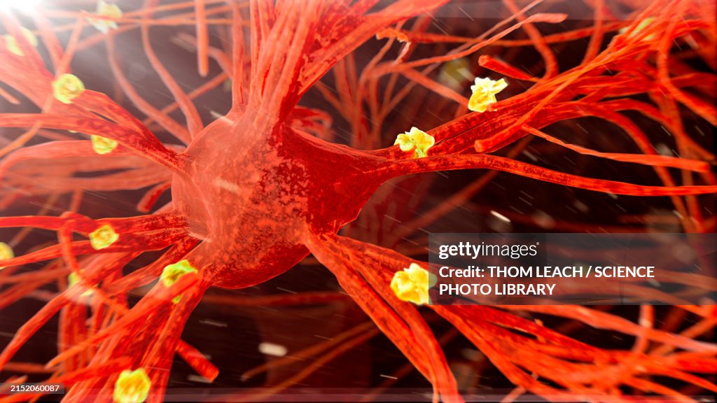 Amyloid plaques on nerve cells, illustration