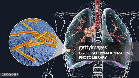 Primary Lung Tuberculosis With Ranke Complex Illustration Ilustración ...