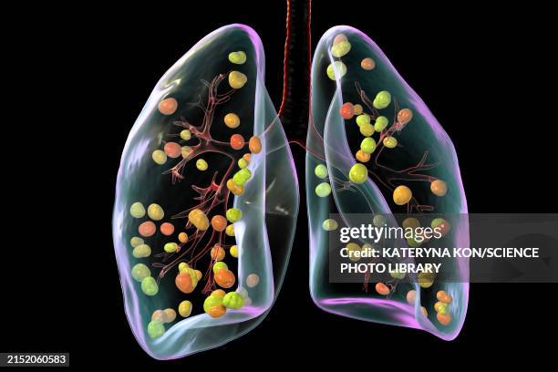 illustrations, cliparts, dessins animés et icônes de lung histoplasmosis, illustration - histoplasma