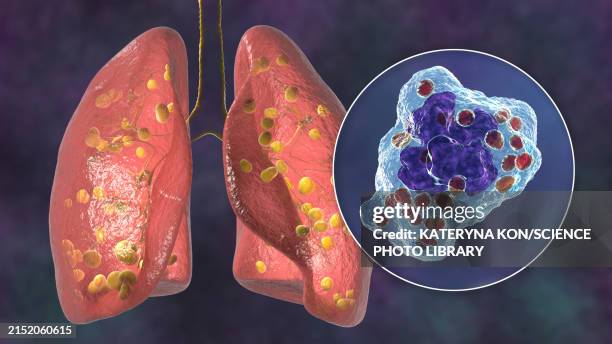 illustrations, cliparts, dessins animés et icônes de lung histoplasmosis, illustration - histoplasma