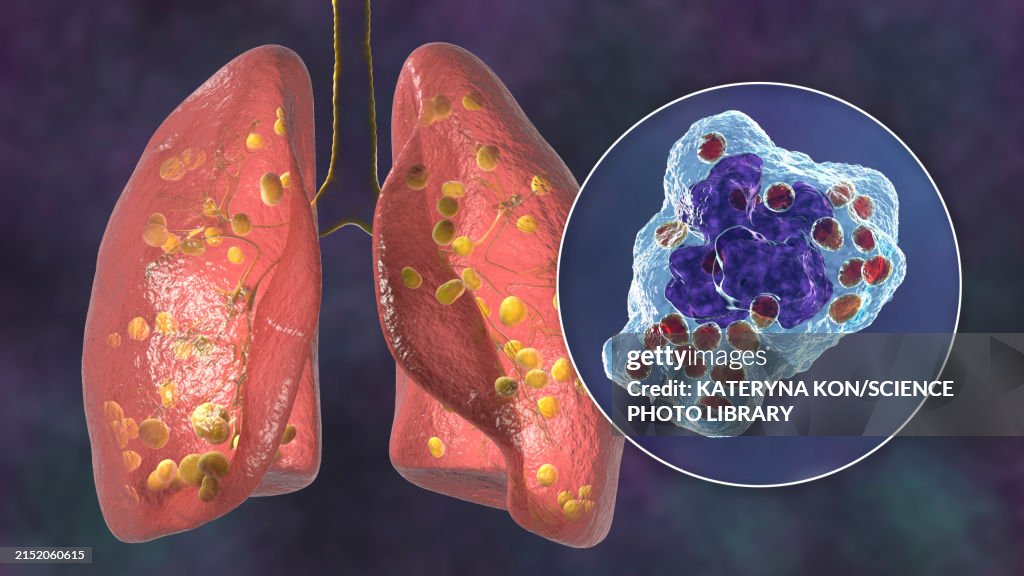 Lung histoplasmosis, illustration