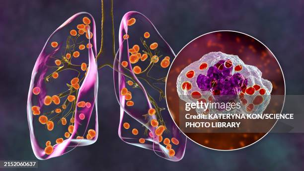 illustrations, cliparts, dessins animés et icônes de lung histoplasmosis, illustration - histoplasma