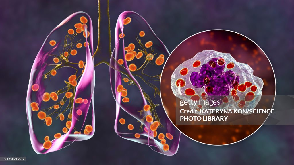 Lung histoplasmosis, illustration