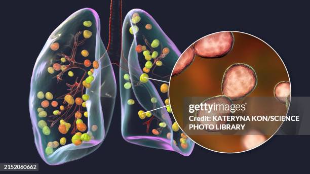 illustrations, cliparts, dessins animés et icônes de lung histoplasmosis, illustration - histoplasma