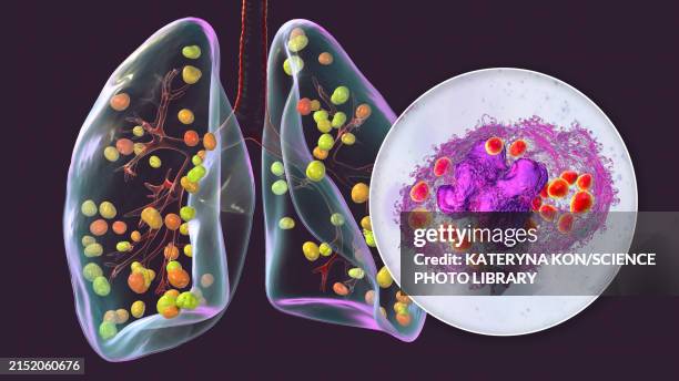 illustrations, cliparts, dessins animés et icônes de lung histoplasmosis, illustration - histoplasma