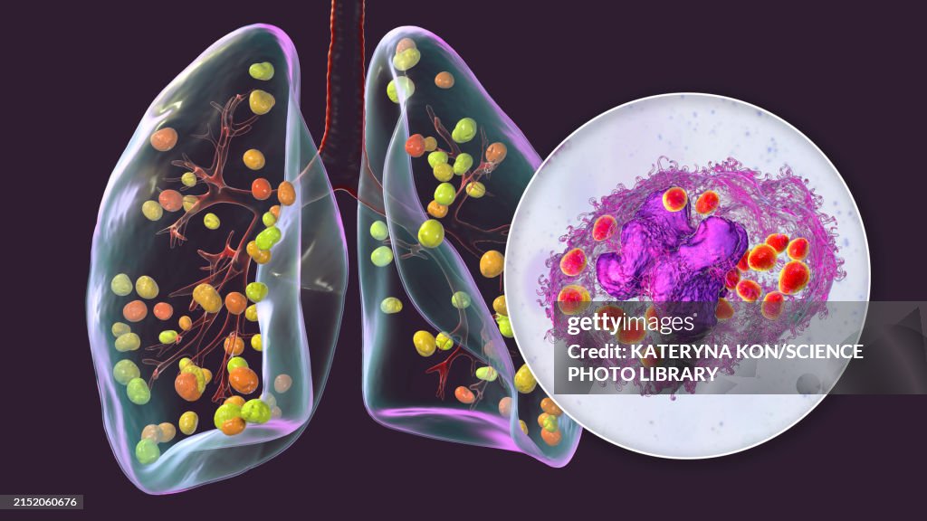Lung histoplasmosis, illustration