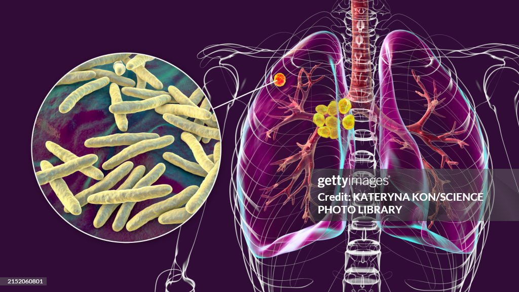 Tuberculosis Letras Primary Lung Tuberculosis Illustration High-Res Vector Graphic - Getty ...