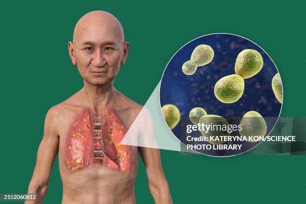 illustrations, cliparts, dessins animés et icônes de lung histoplasmosis, illustration - histoplasma