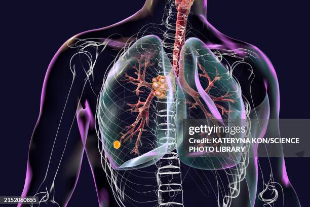202 Lung Lesion Stock Photos, High-Res Pictures, and Images - Getty Images
