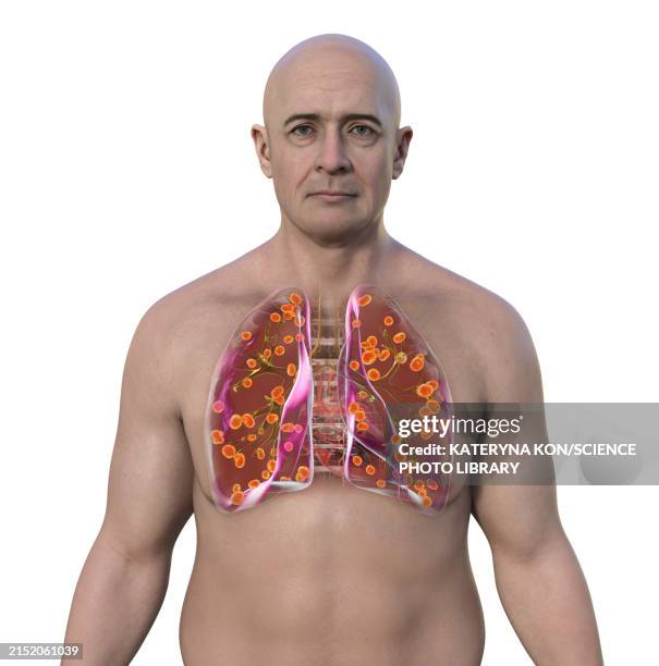 illustrations, cliparts, dessins animés et icônes de lung histoplasmosis, illustration - histoplasma