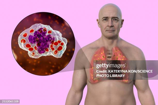 illustrazioni stock, clip art, cartoni animati e icone di tendenza di lung histoplasmosis, illustration - macrofago