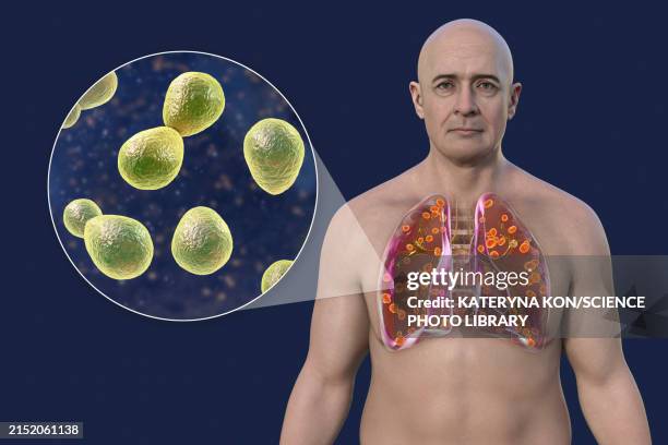 illustrations, cliparts, dessins animés et icônes de lung histoplasmosis, illustration - histoplasma