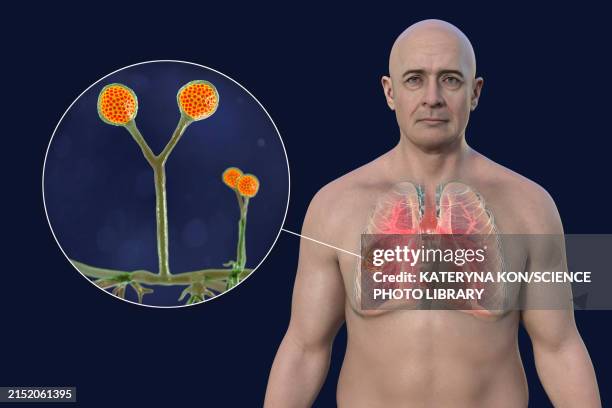 man with lung mucormycosis lesion, illustration - compromised immune system stock illustrations
