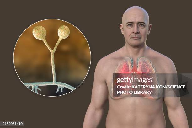 man with lung mucormycosis lesion, illustration - compromised immune system stock illustrations