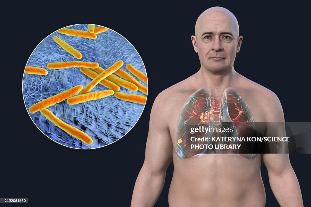 Primary Lung Tuberculosis With Ranke Complex Illustration High-Res ...
