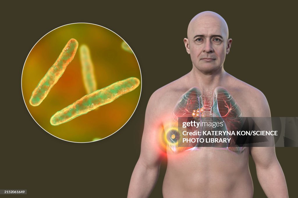 Primary Lung Tuberculosis With Ranke Complex Illustration High-Res ...