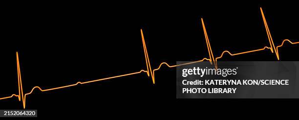ecg with second degree mobitz 2 av block, illustration - av stock illustrations
