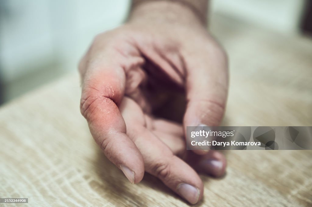 Neurodermatitis, psoriasis on the hand, a on the hand of a man affected by eczema, the concept of the disease. A close up of a red finger with swelling and redness. Pain, itching, peeling in the crook of the finger.