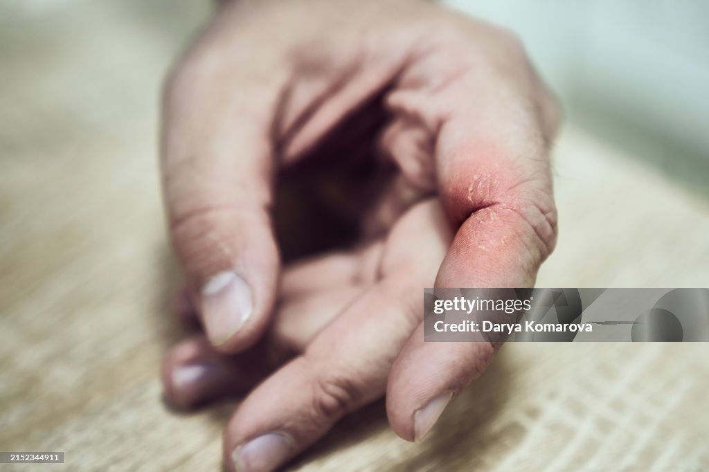 Neurodermatitis, psoriasis on the hand, a on the hand of a man affected by eczema, the concept of the disease. A close up of a red finger with swelling and redness. Pain, itching, peeling in the crook of the finger.