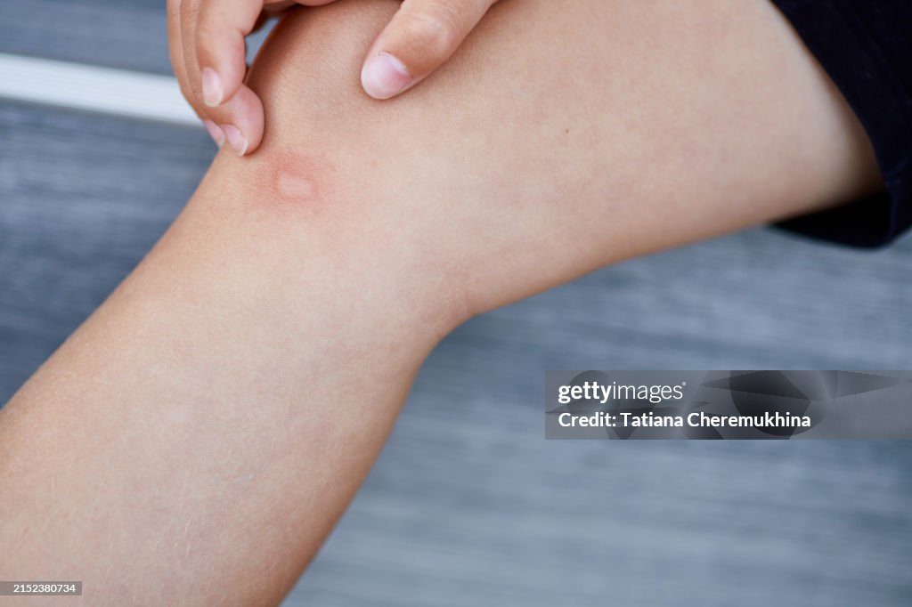 Mosquito bite on a child's leg. The child scratches the bite site.