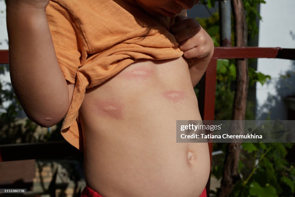 Mosquito bites on a child's torso. Strong allergic reaction