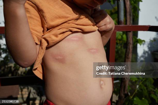 mosquito bites on a child's torso. strong allergic reaction - piqure d'insecte photos et images de collection