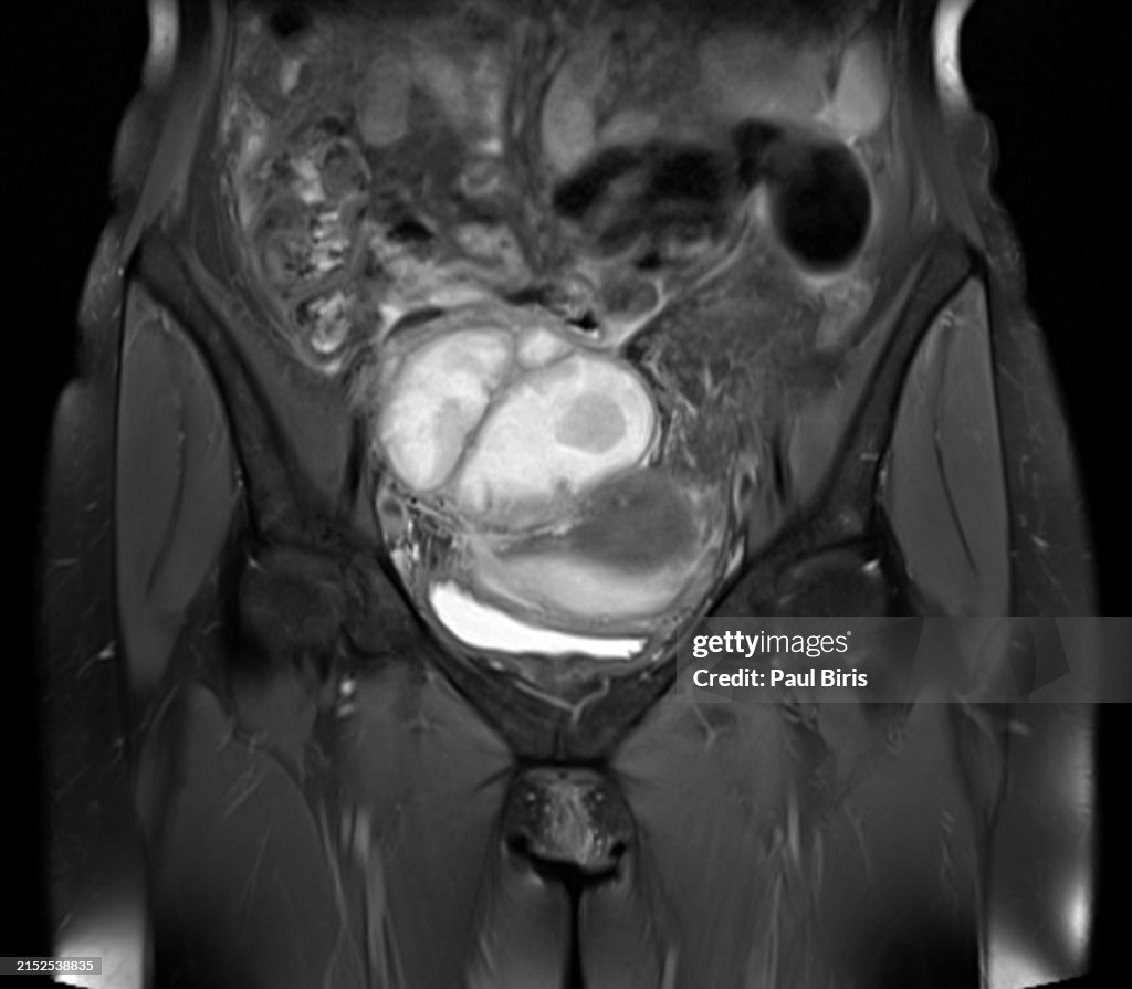 Tubo-ovarian abscess: MRI findings on coronal T2 FatSat image PID Pelvic inflammatory disease