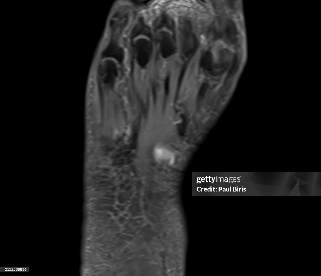 Plantar fibromatosis or Ledderhose disease seen on MRI images, coronal postgadolinium T1 image