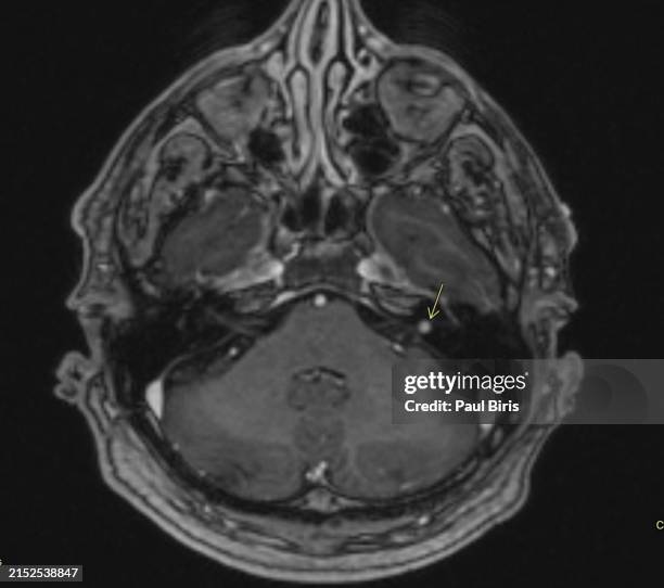 intracanalicular vestibular schwannomas, or acoustic neuromas seen in the left internal auditory canal (iac) on postcontrast axial t1 mri image - temporale kwab stockfoto's en -beelden