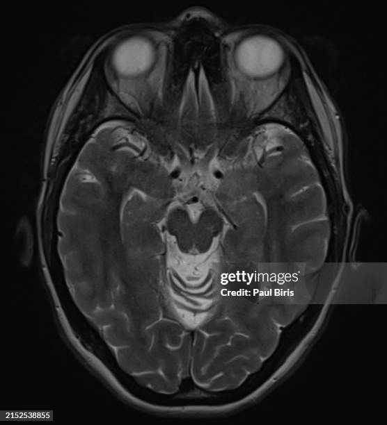 diffuse cerebellar atrophy seen on axial t2 mri image - atrophy stock pictures, royalty-free photos & images