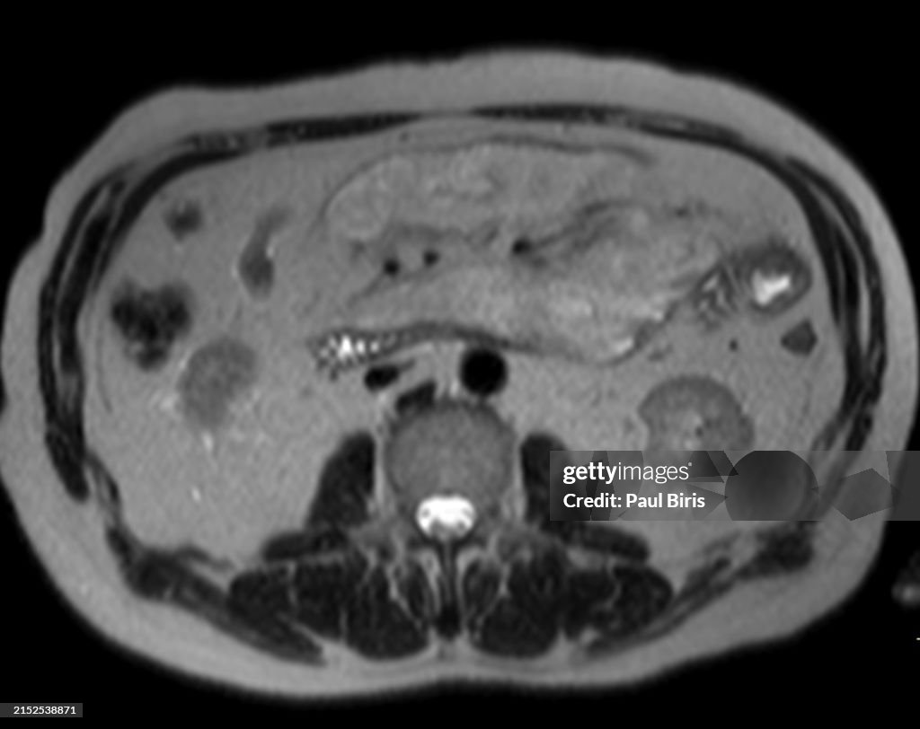 Mesenteric panniculitis seen on magnetic resonance imaging (MRI), axial T2 image
