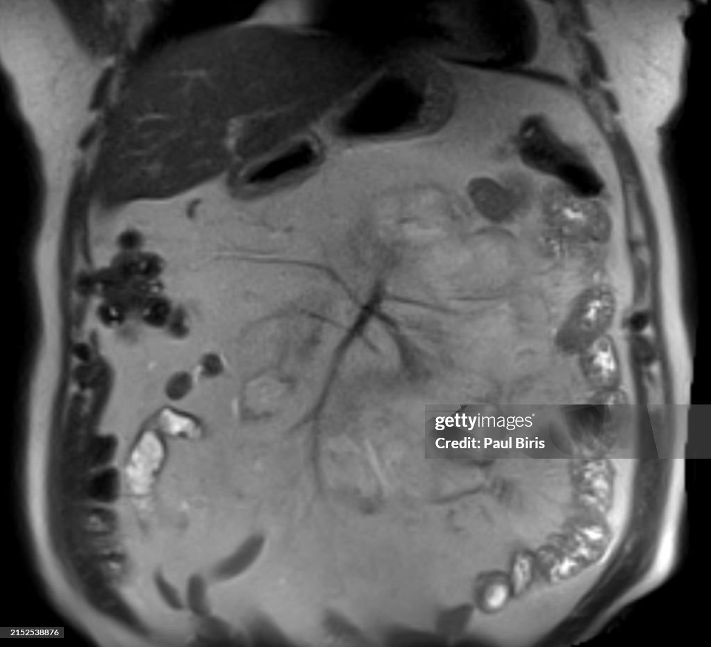Mesenteric panniculitis seen on magnetic resonance imaging (MRI), coronal T2 image