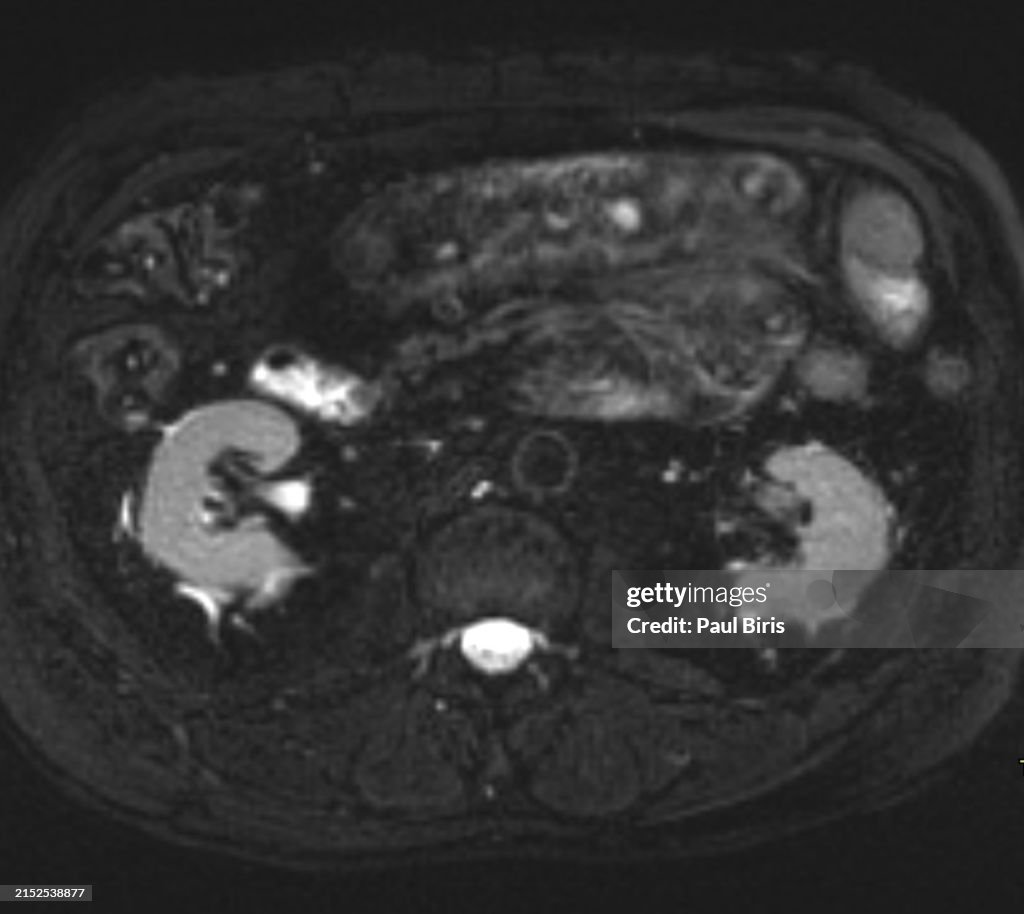Mesenteric panniculitis seen on magnetic resonance imaging (MRI), axial STIR image