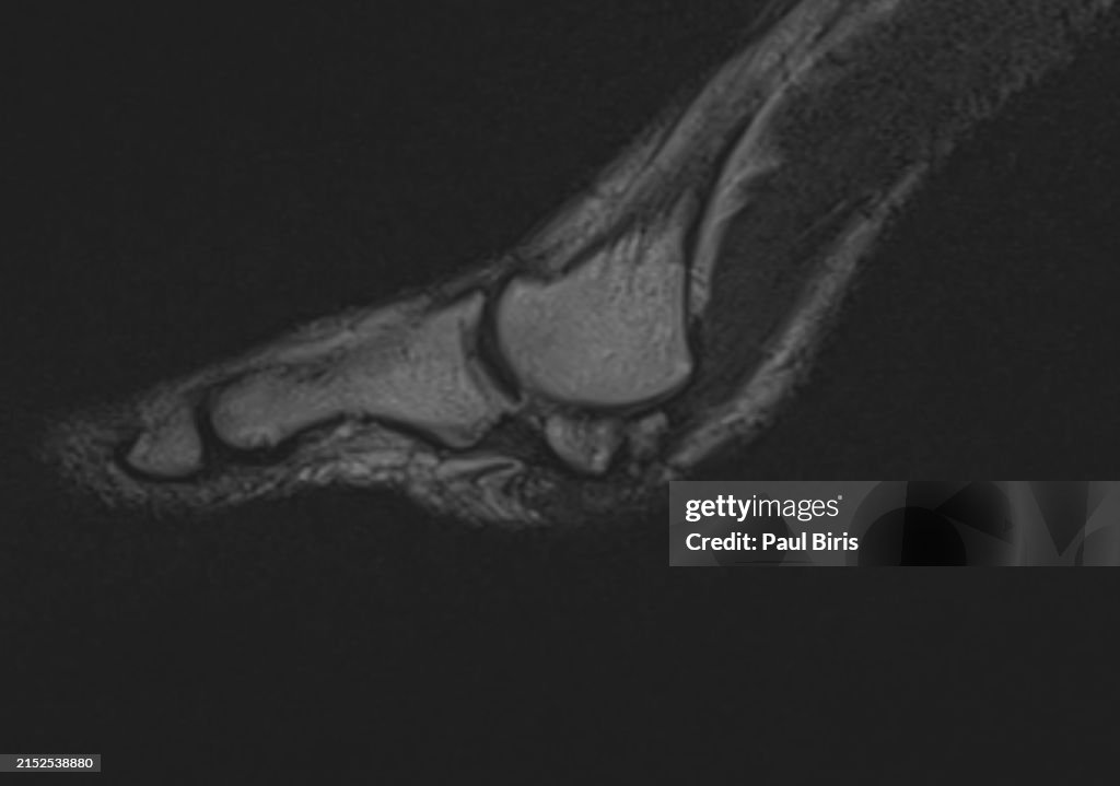 Bipartite Medial Hallux Sesamoid With Sesamoiditis Seen On Mri Magnetic ...