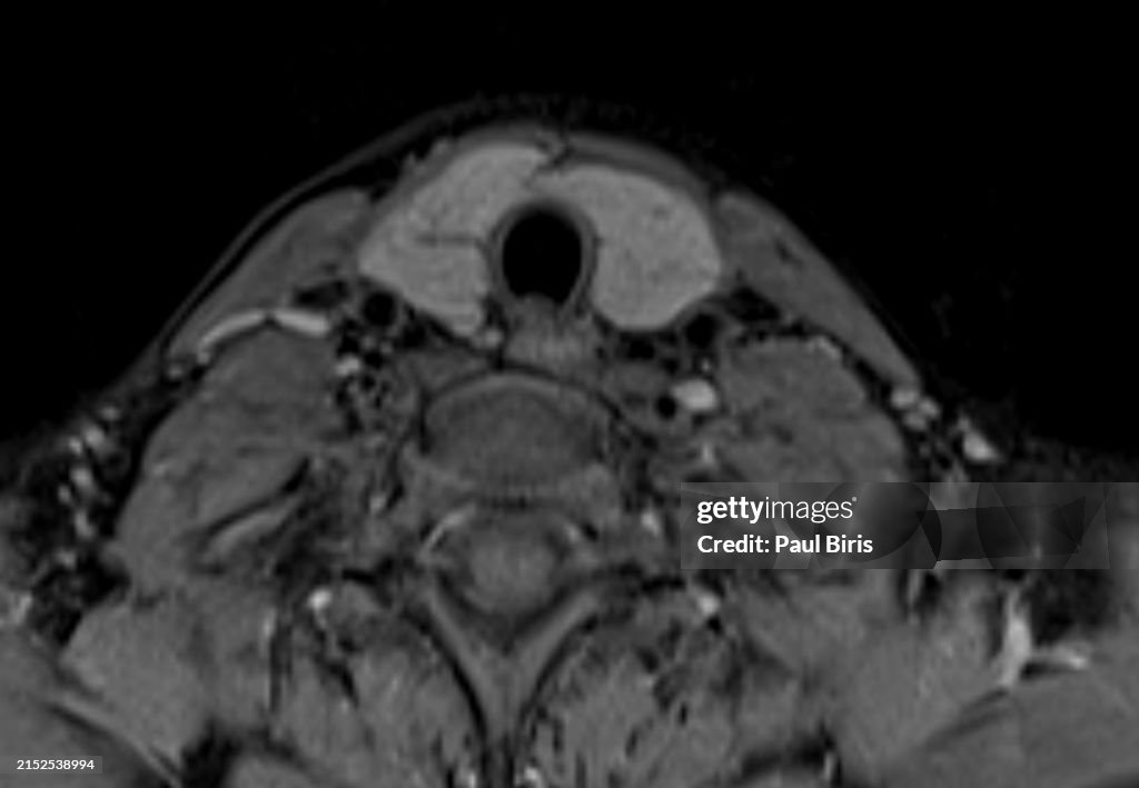 Magnetic Resonance Imaging Features of Incidental Diffuse Thyroid Disease. Hashimoto thyroiditis