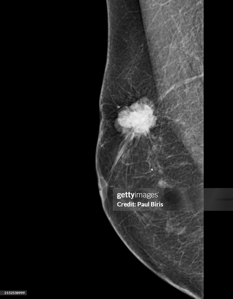 X-ray Digital Mammogram or mammography. Screening Mammogram of Breast Cancer